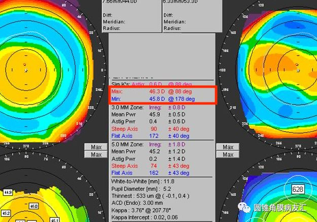 快速入门读懂角膜地形图